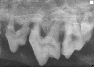 Periodontal Disease