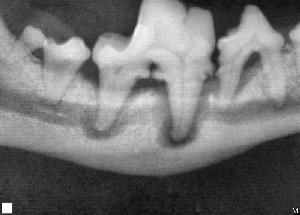 Periodontal Disease