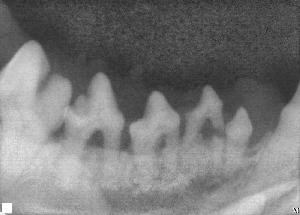 Xray of periodontal disease