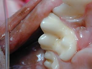 Dental caries