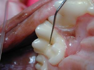 Dental caries