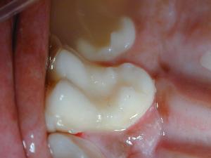 Dental caries