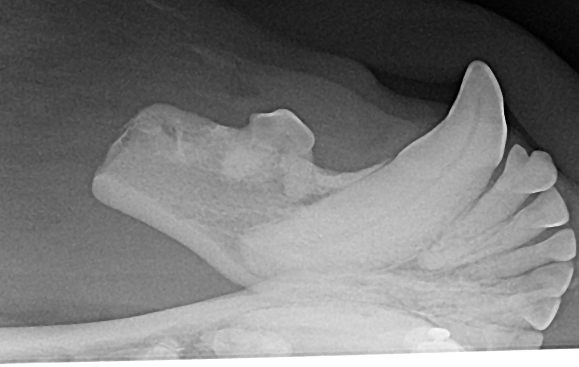 after oral mass removal