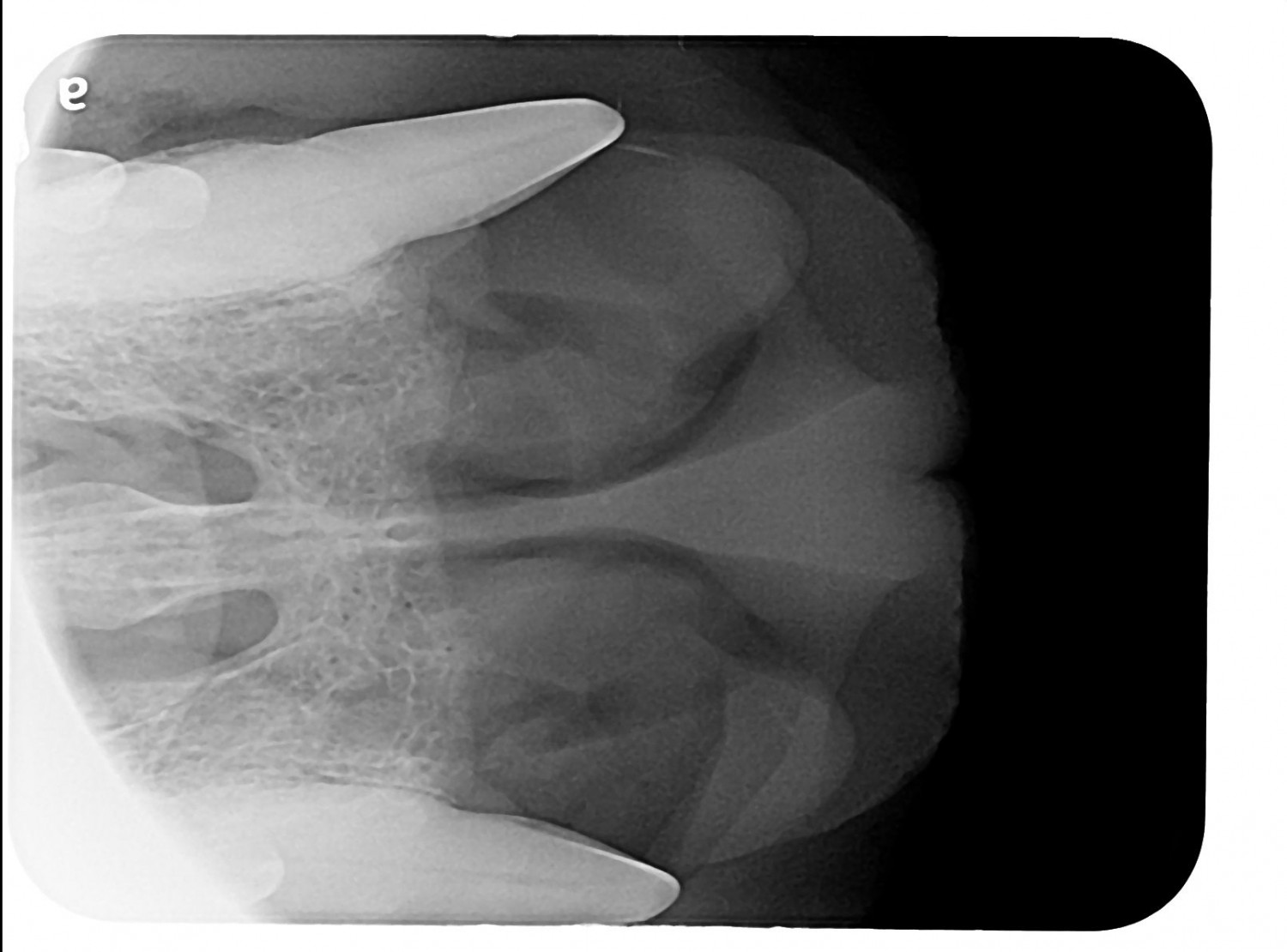 after oral mass removal