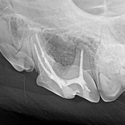 fractured triple-rooted tooth after