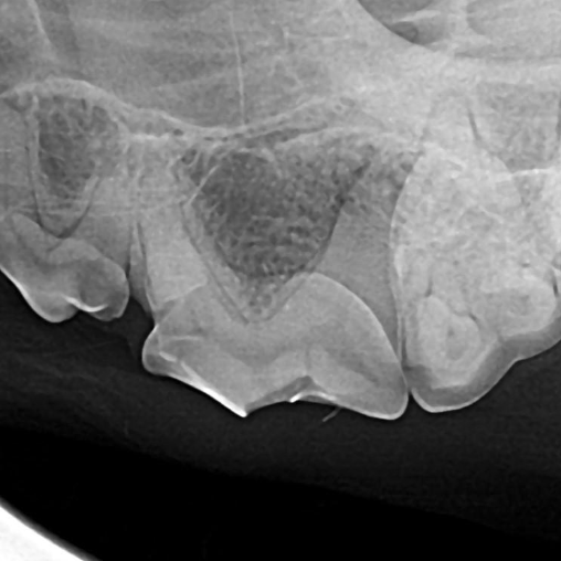 fractured triple-rooted tooth before